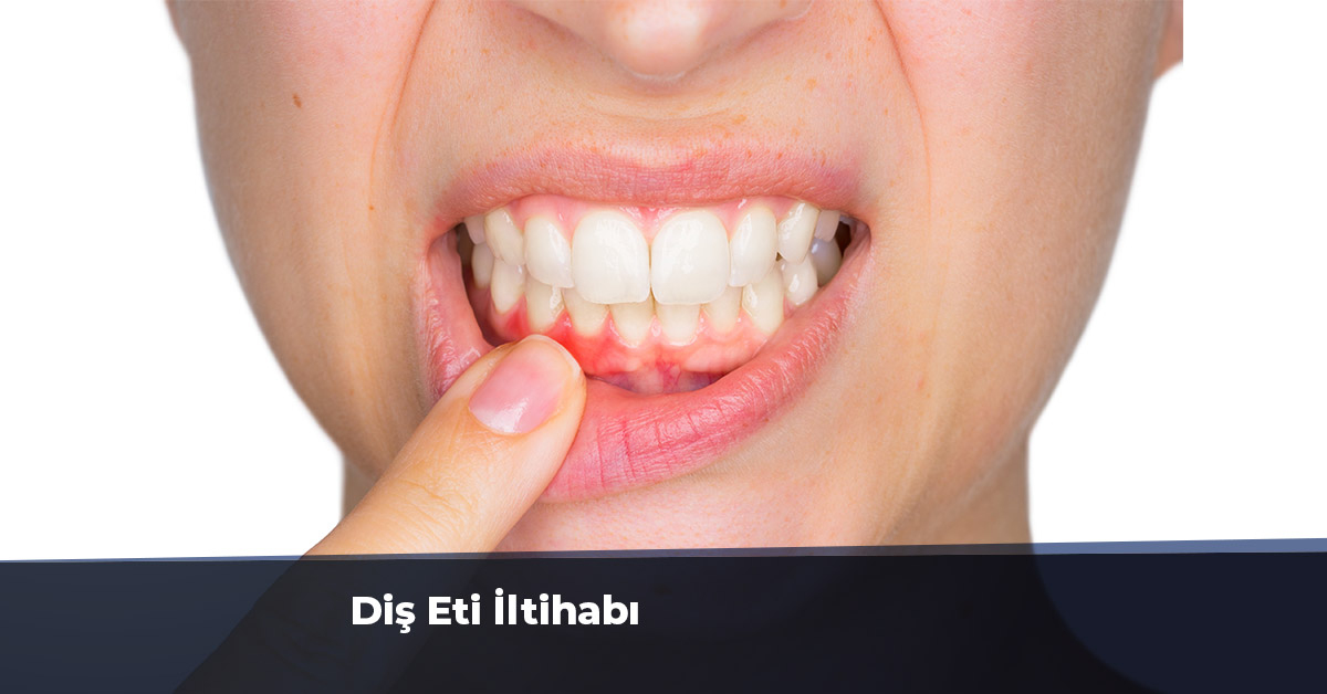 Diş Eti İltihabı - Diş Eti İltihabı Nasıl Geçer? - Gingivitis Tedavisi ilgili Saçların Kopması Neden Olur