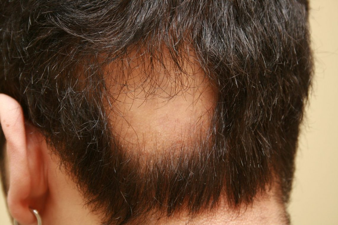 Saç Kıran Sonrası Dökülen Saçlarımız Geri Gelir Mi? - İlhan Serdaroğlu tamamen Rüyamda Saçlarımın Dökülmesi Ne Anlama Geliyor