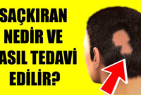 Saçkıran Nedir Ve Nasıl Tedavi Edilir? - Youtube içeride Saç Kopması Neden Olur