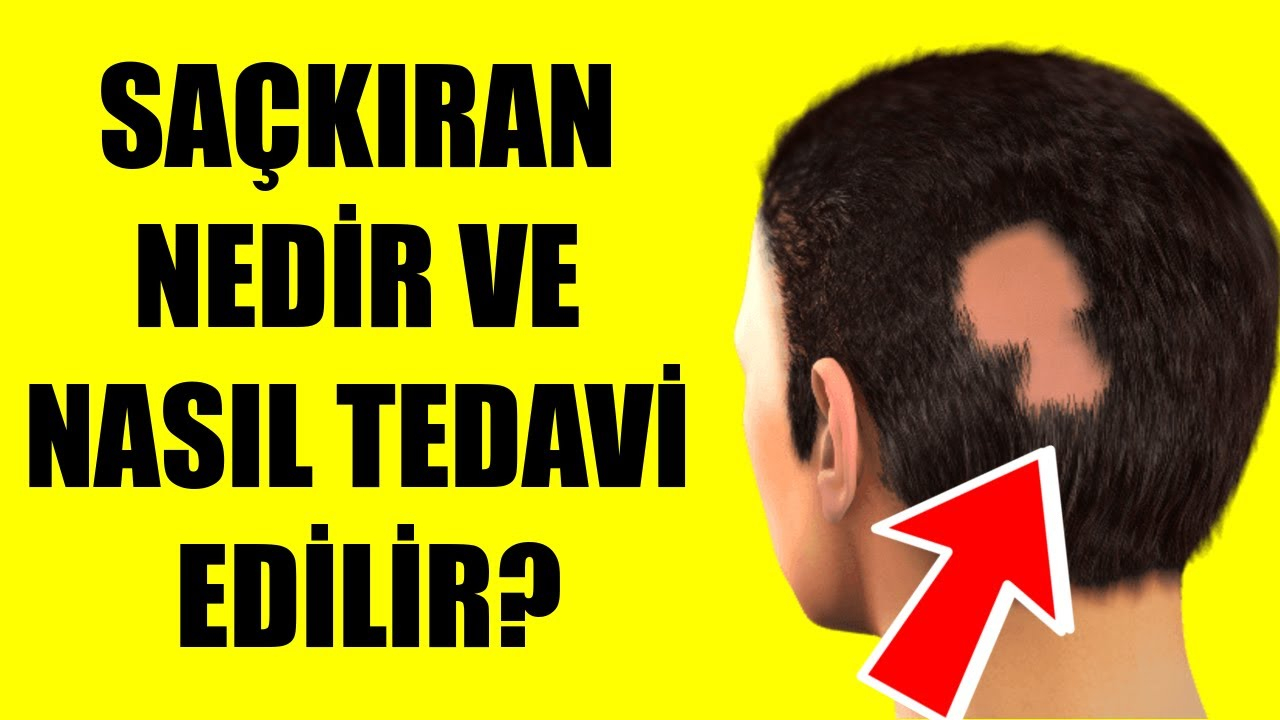 Saçkıran Nedir Ve Nasıl Tedavi Edilir? - Youtube içeride Saç Kopması Neden Olur