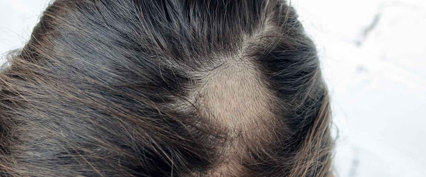 Saçkıran(Alopesi Areata) Nedir? Saçkıran Belirtileri Ve Tedavi ile Saçta Koparak Dökülme Neden Olur